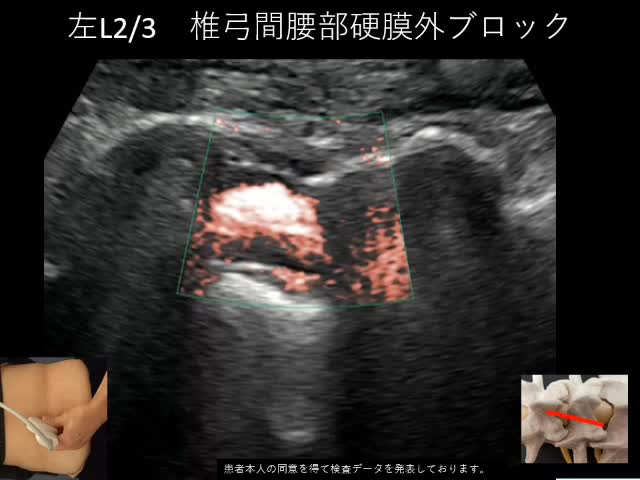 動画1　腰部硬膜外ブロック解剖手技説明...
