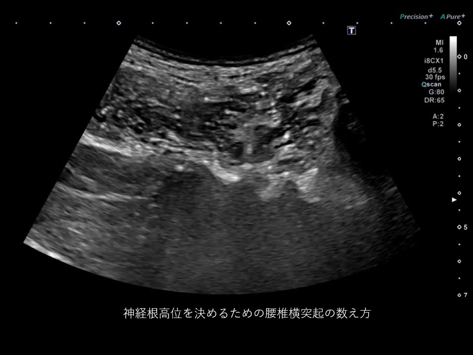 動画2　神経根高位を決めるための腰椎横突起の数え方...