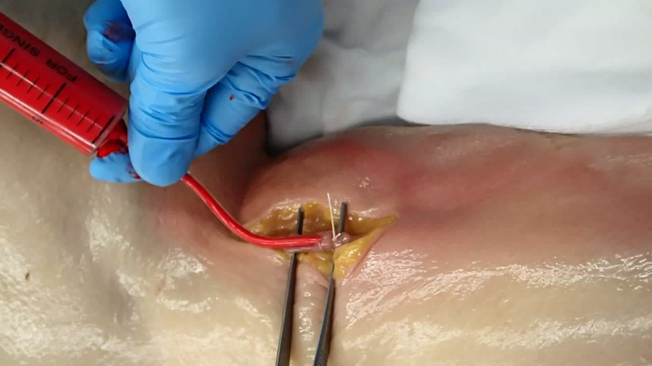 動画1  血管への樹脂注入