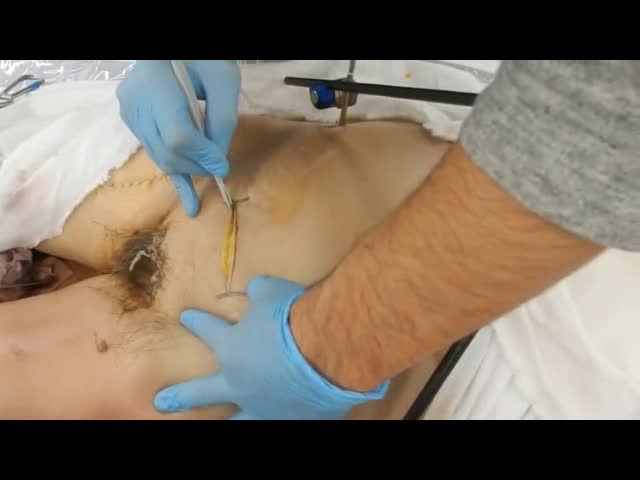 動画2　ガーゼパッキングの実際