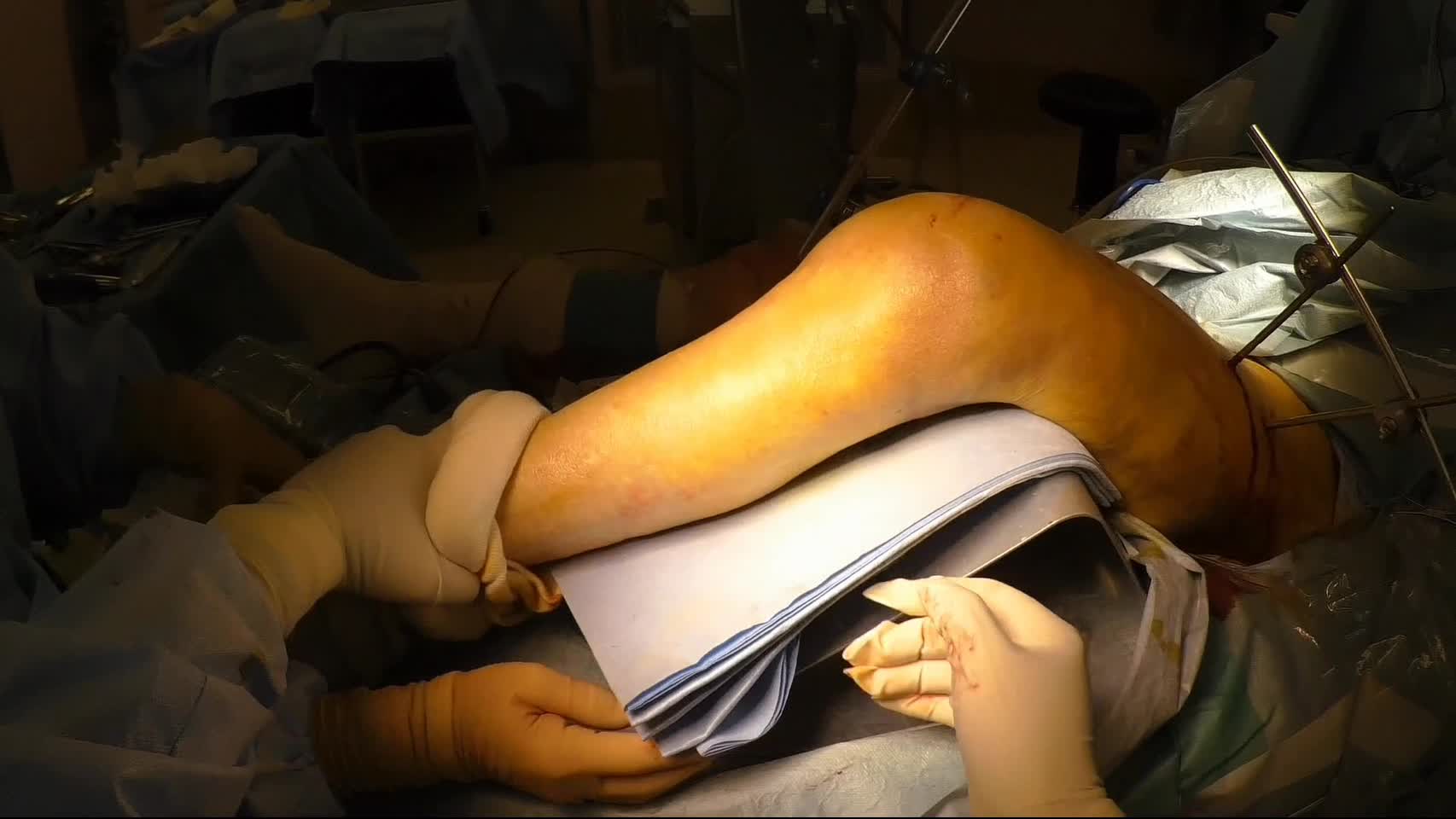 動画1　大腿骨遠位端骨折に対する外側アプローチ...