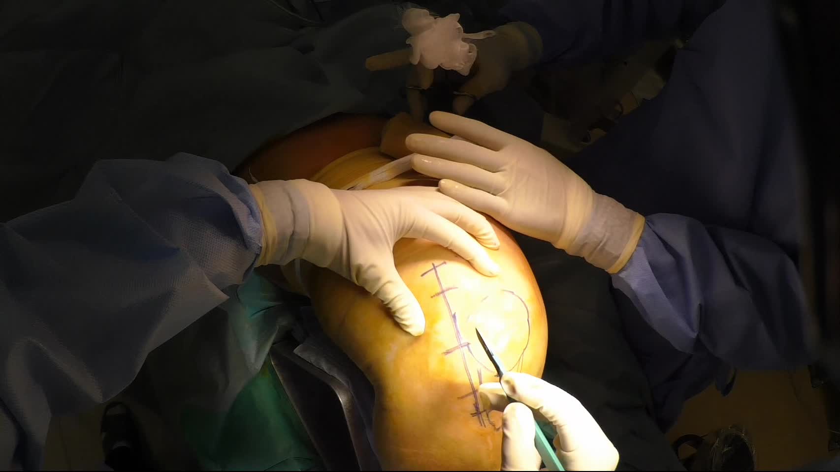 動画２　大腿骨遠位端骨折に対する外側傍膝蓋アプローチ...