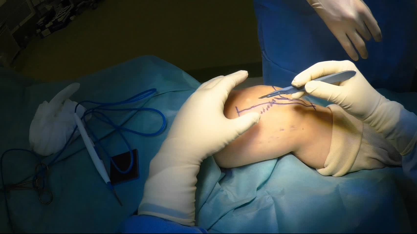 動画３　大腿骨遠位端骨折に対する内側傍膝蓋アプローチ（subvastus approach）...