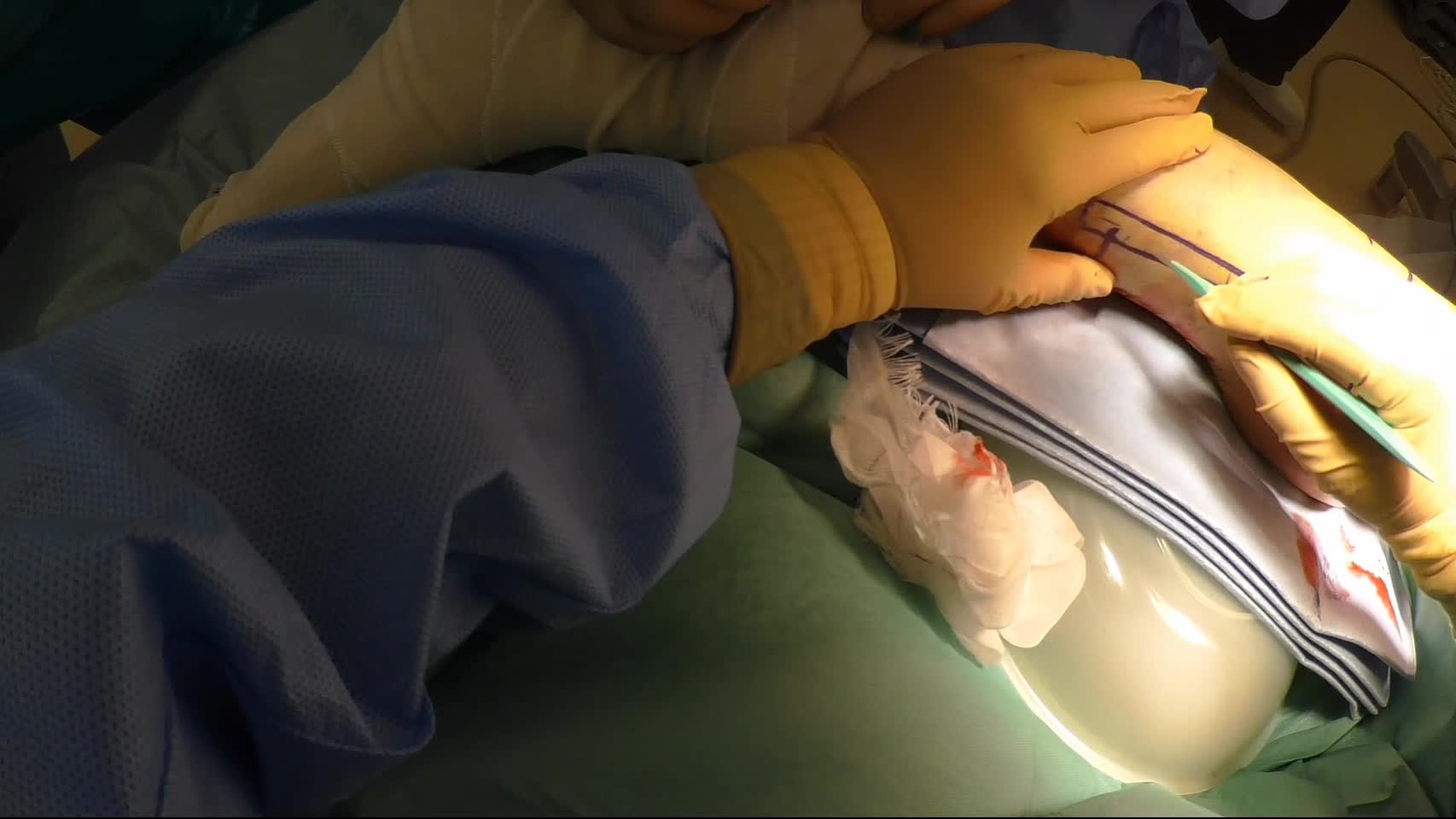 動画6　脛骨近位端骨折に対する後内側アプローチ...